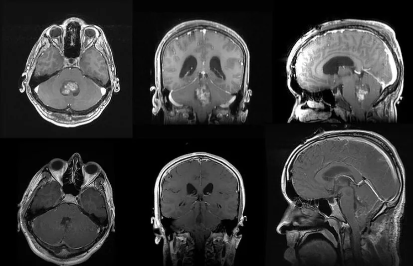MRI images from Alex's 2016 brain-tumor diagnosis.